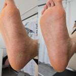 컴풋 문제성 손,발톱 / 젤네일