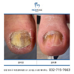문제성발관리센터 메디푸스 내성발톱 무좀 각질 문제성발톱