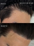 다린스칼프