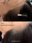 다린스칼프