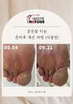 레푸스 발각질 내성발톱