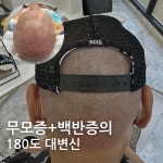 밀스칼프SMP 대구본점