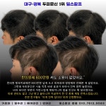 밀스칼프SMP 대구본점
