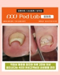 에벤에셀두피관리&발관리 | 케어센터 포디랩응암점 내성 무좀 발각질 두피관리 젤네일