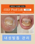 에벤에셀두피관리&발관리 | 케어센터 포디랩응암점 내성 무좀 발각질 두피관리 젤네일