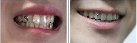 치아 반짝이는 '투스젬' 시술…치과의사들은 말린다, 왜?