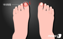 엄지발가락 욱신…발톱 너무 짧게 자르면 내성발톱 생긴다