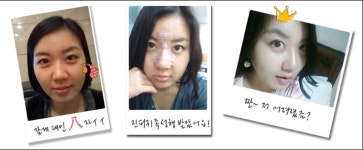 파슨스엔코 | 자연스럽고 완벽한 코 라인을 원한다면…리엔장성형외과 자가진피 코성형술 연일 화제
