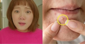 “'여드름 짜야 된다' vs '짜면 절대 안 돼', 진짜 정답을 알려드릴게요”
