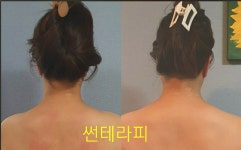 썬테라피
