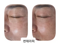 썬테라피