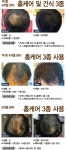 씨에스엘엠지에프두피탈모센타성성 | 엠지에프두피탈모 전문센터 분당야탑점