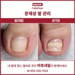 독일식문제성손발관리전문점푸스플레게장연자 | 아토네일 & 베어푸스플레게 무좀발톱 내성발톱