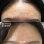 불레부뷰티강동지사플라즈마 | 플라즈마불레부뷰티