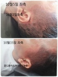 원포인트 콜드플라즈마 용산 | 원포인트 콜드플라즈마