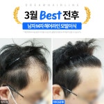 이재남헤어라인 | 드림헤어라인의원
