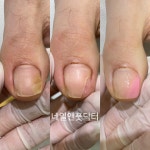 미니네일닥터아이티엔광 | 네일앤풋닥터
