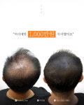 생명나무두피프렌즈 | 두피움SMP