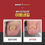 독일식문제성손발관리전문점푸스플레게장연자 | 아토네일 & 베어푸스플레게 무좀발톱 내성발톱