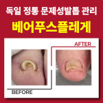 독일식문제성손발관리전문점푸스플레게장연자 | 아토네일 & 베어푸스플레게 무좀발톱 내성발톱