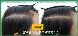 애터미 마포 0.3 센터 | 탈모 아미치 0.3 공덕점