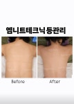 썬테라피