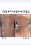 썬테라피