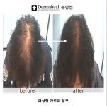 씨에스엘엠지에프두피탈모센타성성 | 엠지에프두피탈모 전문센터 분당야탑점