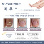 레푸스이천점 발각질 문제성발 전문점 | 레푸스 이천점 풋케어 발톱 발각질 문제성 발관리
