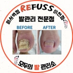 레푸스이천점 발각질 문제성발 전문점 | 레푸스 이천점 풋케어 발톱 발각질 문제성 발관리