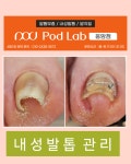 에벤에셀두피관리&발관리 | 케어센터 포디랩응암점 내성 무좀 발각질 두피관리 젤네일