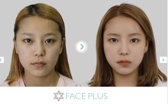 안면윤곽 잘하는곳,광대축소술 잘하는 성형외과 추천 - Daum 카페 강남... 페이스플러스,비절개 안면윤곽 잘하는곳,광대축소술 잘하는 성형외과 추천