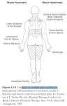 Stratification or Layer Syndrome - therapeutic exercise - 치료적 맞춤운동, 비타미네, 영성 연구소 Stratification or Layer... 