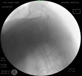경추궁 경막외주사(translaminar epidural injection) -경추부 - 척추시술법 - 등편한재활의학과의원 경추궁 경막외주사... 