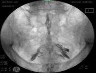 경 미추 경막외주사(caudal block) - 척추시술법 - 등편한재활의학과의원 경 미추 경막외주사(caudal block)
