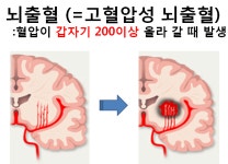 고혈압성 뇌출혈 치료 - 통합 게시판 - 뇌동맥류, 뇌졸중, 안면경련, 삼차신경통, 수근관증후근 수술 고혈압성 뇌출혈 치료