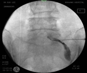 경추간공 경막외주사(transforaminal epidural steroid injection)-요추부 - 척추시술법 - 등편한재활의학과의원 경추간공... 