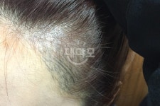 헤어라인문신 망한거 사진올려요~ > 대다모 > 모발이식 FORUM