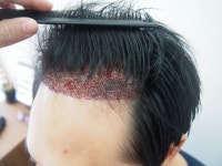 비절개 3090모 10월 13일 수술진행하였습니다. 비절개 3090모 10월 13일 수술진행하였습니다. > 대다모 > 모발이식포토평가