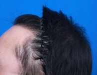 포토평가10 -이규호 모아름 모발이식센터 (9개월차) 포토후기10 -이규호 모아름 모발이식센터 (9개월차) > 대다모 > 모발이식포토평가