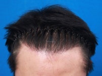 포토평가10 -이규호 모아름 모발이식센터 (9개월차) 포토후기10 -이규호 모아름 모발이식센터 (9개월차) > 대다모 > 모발이식포토평가