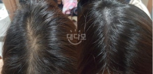 저 두피문신했어요! 괜찮은가 봐주세용>< 저 두피문신했어요! 괜찮은가 봐주세용>< > 대다모 > 두피문신포토평가