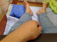 한의원에서 침 맞눈데.. | 보배드림 시승기/배틀/목격담