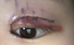 쌍수2일짼데 이거 멍이야? (혐오주의) - 인스티즈(instiz) 뷰티 카테고리 쌍수2일짼데 이거 멍이야? (혐오주의)