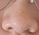 내 블랙헤드 피부과에서 뭐 받아야 할까.... 나보다 심한 사람 장담컨데... 블랙헤드 피부과에서 뭐 받아야 할까.... 나보다 심한 사람 장담컨데... 