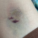 채혈했는데 역대급 멍 들었다...^^ - 인스티즈(instiz) 일상 카테고리 채혈했는데 역대급 멍 들었다...^^