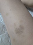 몸에 자꾸 멍이 심하게 생겨 - 인스티즈(instiz) 일상 카테고리 몸에 자꾸 멍이 심하게 생겨