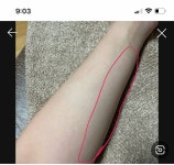 팔 안쪽 너무 아픈데 왜그런지 아는읻... - 인스티즈(instiz) 일상 카테고리