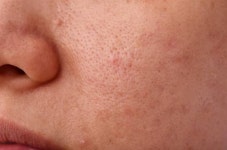 홍조 vs 기미 vs 모공 뭐가 젤 스트레스임? - 인스티즈(instiz) 일상 카테고리 홍조 vs 기미 vs 모공 뭐가 젤 스트레스임?