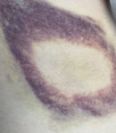 멍이 이정도 들었는데 언제 빠질까(멍사진있음) - 인스티즈(instiz) 일상 카테고리 멍이 이정도 들었는데 언제 빠질까(멍사진있음)